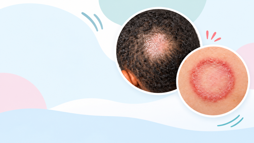 Increase in Ringworm Cases